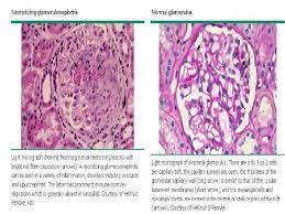 It classically presents with involvement of the upper and lower respiratory and. Granulomatosis De Wegener