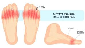 Image result for Metatarsalgia