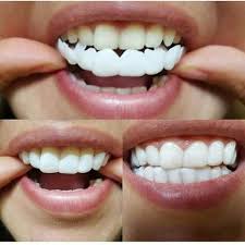 Veneers Cost Clip On Press On Veneers Kit At Home Do It Yourself Snap Smileonetwo Veneers Teeth Veneers Teeth Cost Veneers Cost