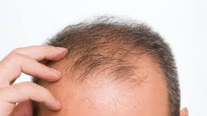 Be aware that sometimes female hair loss cure can be different than male hair loss cure, especially if the main problem is hormones. Baldness Solution Breakthrough Discovered By Scientists Us News Sky News