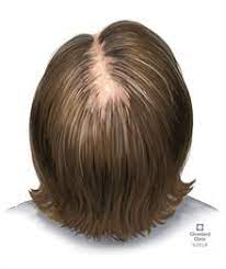 Telium effluvium (te) and androgenic alopecia are two types of hair loss thought to be caused (at least in part) by an increase in male hormones called androgens. Hair Loss In Women Causes Treatment Prevention