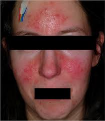 Résultat de recherche d'images pour "rosacea"