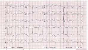 Pin By Alina Kanaykina On Doktor In 2020 Subclavian Artery Thrombosis Arteries