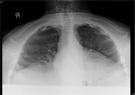Tanawin, my kino, pagtanaw, viewaction, pagsalingit, viewing deck. Anti Tuberculosis Medication Induced Oculogyric Crisis And The Importa Imcrj
