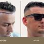 hair transplant in islamabad from thecapitalaesthetic.com