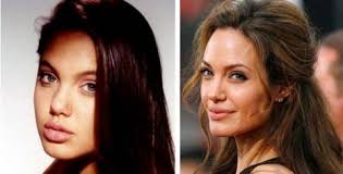 Sztárok plasztika előtt és után!