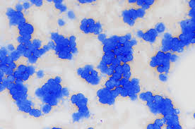 Targeting protein has potential to treat leukemia, lymphoma: Newsroom