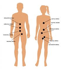 Image result for stomach hernia symptoms