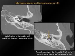 Image result for Myringosclerosis