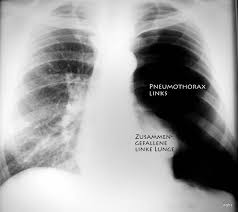 We did not find results for: Wolfgang G H Schmitt De Pneumothorax Ohne Und Mit Risikofaktoren Spannungs Pneumothorax