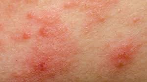 Image result for dermatitis contacta