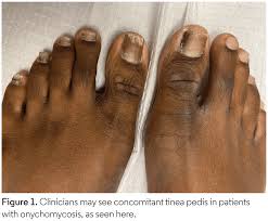 Image result for Onychogryphosis feet
