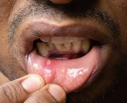 Image result for Mouth ulcers symptoms roof of the mouth