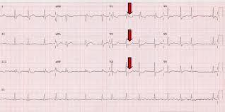 Both produce the same spectrum of ecg changes and symptoms and are managed identically in the emergency department. Apresentacoes Atipicas Do Infarto Agudo Do Miocardio No Eletrocardiograma