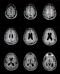 Mri Reveals Smouldering Ms Lesions Ms Trust