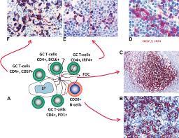 Nodular Lymphocyte Predominant Hodgkin Lymphoma Nlphl The Composite Download Scientific Diagram