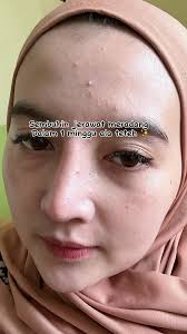 Testimoni Teteh: Kesembuhan Kulit dengan Ainy Skincare
