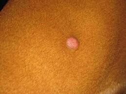 Intestinal cancer throws up symptoms that are similar to symptoms caused by inflammation or obstruction in the intestinal passage. Warning Signs Of Cancer In Dogs