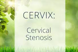 Cancer screening aims to detect disease early in asymptomatic people through the application of examinations or procedures. Cervical Stenosis Causes Symptoms And Treatment Dr T