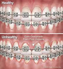 Here are seven cavity symptoms to watch out for. Oral Hygiene Chermak And Hanson Orthodontics Winston Salem Nc