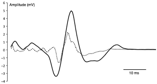 Example Of Motor Evoked Potential Mep By Transcranial Magnetic Download Scientific Diagram