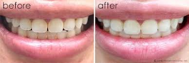Crest 3d White Whitestrips With Light Christina Truong Crest 3d White Whitestrips Crest White Strips