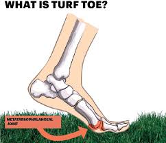 Turf toe doesn't sound like much but it has taken out the toughest of professional athletes. C Mon Man Turf Toe Is That Even A Real Thing