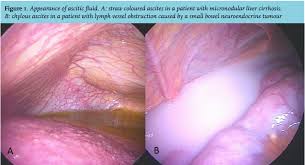 Maybe you would like to learn more about one of these? Article The Diagnostic Work Up In Patients With Ascites Current Guidelines And Future Prospects Full Text October 2016 Njm
