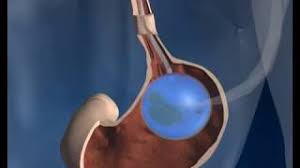 Obesity Surgery Ballarat Bariatrics