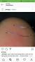 What Do Dead Hair Follicles Look Like