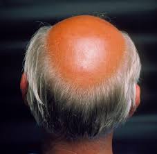 La pelade diffère de la calvitie qui, elle, cause une perte de cheveux et non de poils. Alopecie Troubles Dermatologiques Edition Professionnelle Du Manuel Msd