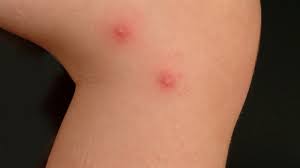 Wir verraten, wie sie warnzeichen erkennen. Culicosis Bullosa Altmeyers Enzyklopadie Fachbereich Dermatologie