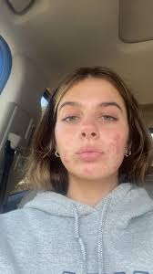 How to get rid of acne?