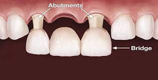 Dental Bridge Cosmetic Dentistry Dentist In Royal Palm Beach