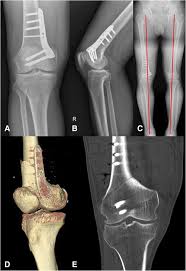A ct scan takes pictures of the inside of the body. Case Report Migration Of A Broken Screw To The Knee Joint After Hardware Failure Following Closing Wedge Distal Femoral Osteotomy Bmc Musculoskeletal Disorders Full Text