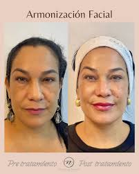 La belleza está en el ojo de quien la mire, sin embargo existen  proporciones, volúmenes y calidad de la piel que le suman belleza al  rostro. En este caso le realicé a