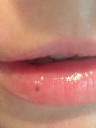 Schwarzer Fleck Unter Der Haut Der Unterlippe Flecken Lippe