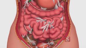 New Adhesion Treatment Offers Pain Relief Youtube