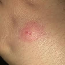 Image result for große winkelspinne biss haut reaktion