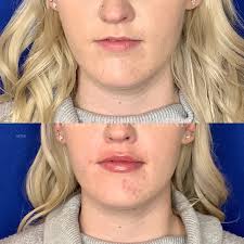 Beth Myrick, ARNP Nurse Injector