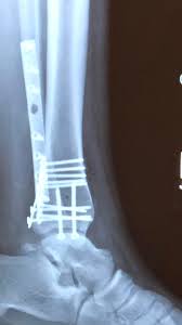 But there's a lot more to the story, a story i wasn't sure i wanted to tell because i'd rather pretend this nightmare never happened. Broken Ankle Surgery Recovery After Trimalleolar Fracture Whole Kitchen Sink