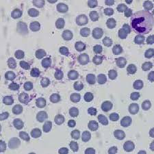 Plasmodium falciparum is a unicellular protozoan parasite of humans, and the deadliest species of plasmodium that causes malaria in humans. Pdf Mixed Infection Of Plasmodium Malariae And Plasmodium Falciparum A Case Report