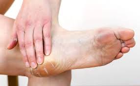 Les cors se produisent à cause d'une accumulation de kératine à la suite d'un compactage des cellules mortes de la peau. 5 Traitements Naturels Contre Les Cors Au Pied Ameliore Ta Sante