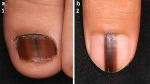 Image result for Acral lentiginous melanoma nail