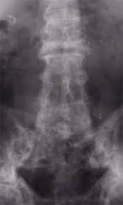 Paget S Disease Of Bone Uconn Musculoskeletal Institute