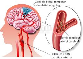 Există două tipuri principale de tumori: Avc Ischemic Ischemia Cerebrala