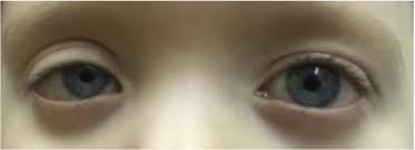 Infantile Horner Syndrome Due To Ectopic Cervical Thymus Gland Canadian Journal Of Ophthalmology