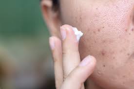 Check spelling or type a new query. Tretinoin For Acne How To Use It Efficacy Side Effects And More