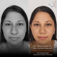 RINOPLASTIA EN MUJERES » ORL FACE