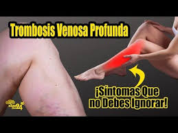 Si observamos síntomas de trombosis estas terapias nos pueden ayudar: Trombosis Venosa Profunda Sintomas No Debes Ignorar Nunca Youtube En 2021 Trombosis Venosa Profunda Trombosis Venosa Trombosis